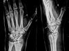 Neglected transscaphoid perilunate fracture dislocation