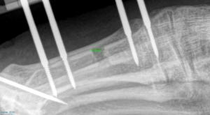 Parmak uzatma ameliyatları