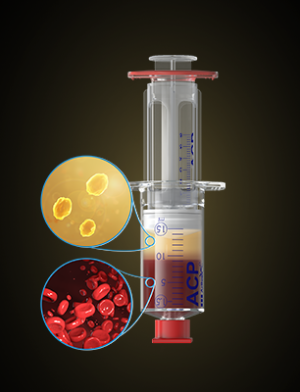 PRP  Plateletten zenginleştirilmiş plazma
