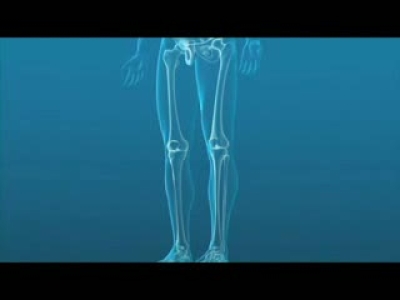 Knee arthroplasty -animation