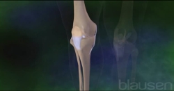 ACL reconstruction